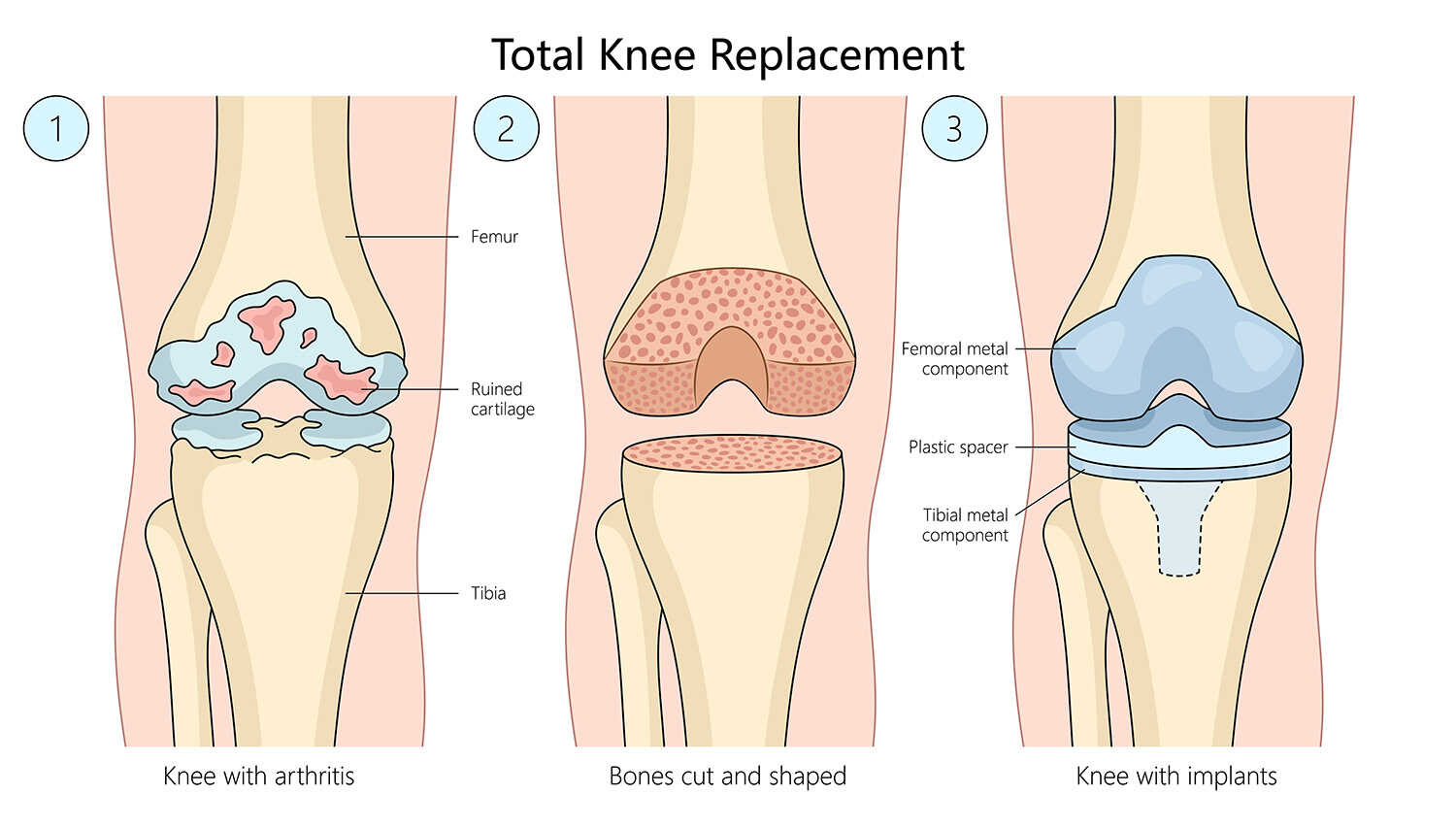 indikasi total knee replacement